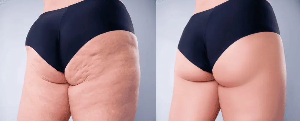 Before and after cellulite treatment comparison