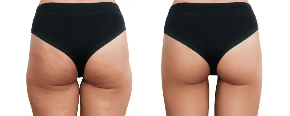 Before and after body contouring comparison