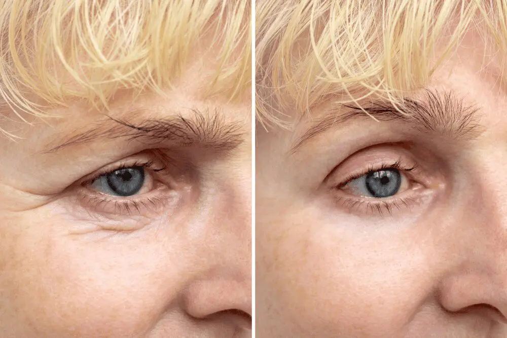 Wrinkle reduction before and after