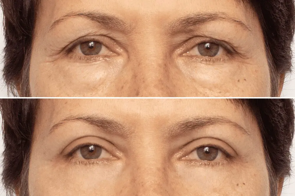 Upper and lower eyelid transformation
