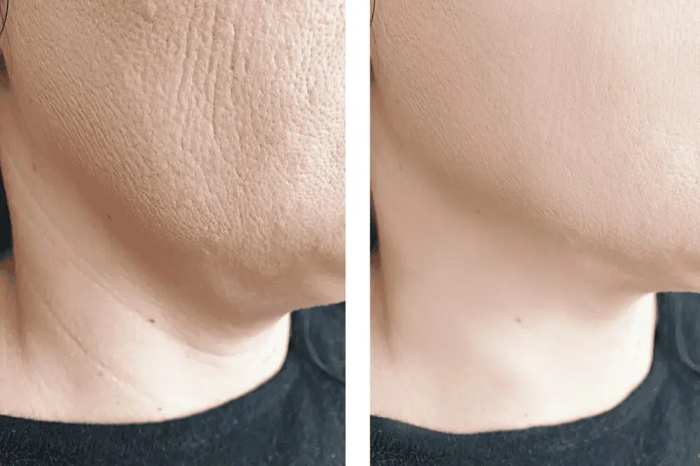 Skin smoothness improvement in two images