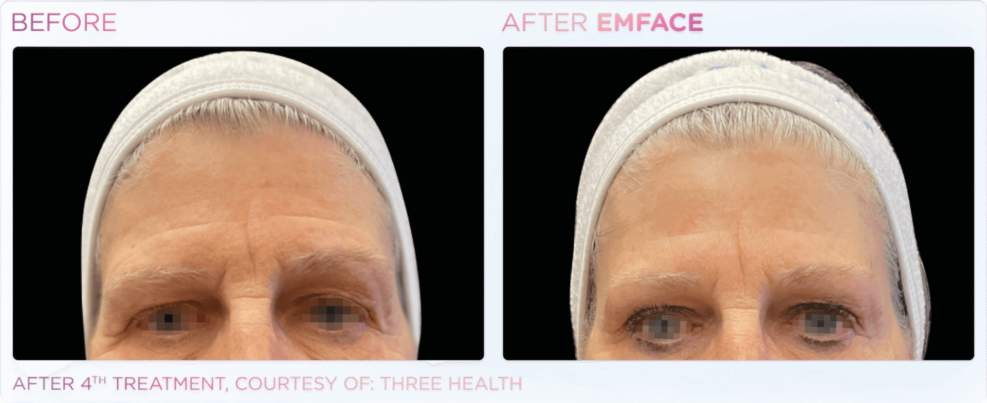 Woman's facial treatment results comparison