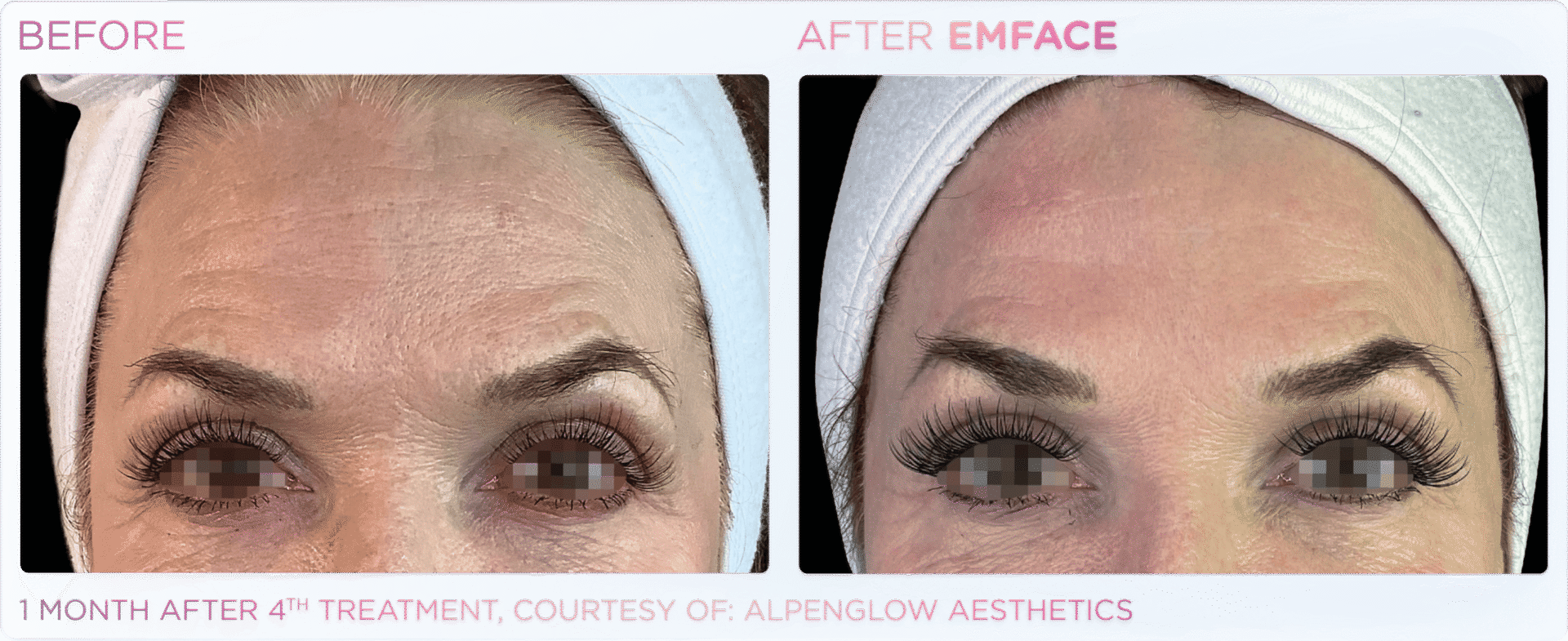 Forehead treatment results comparison