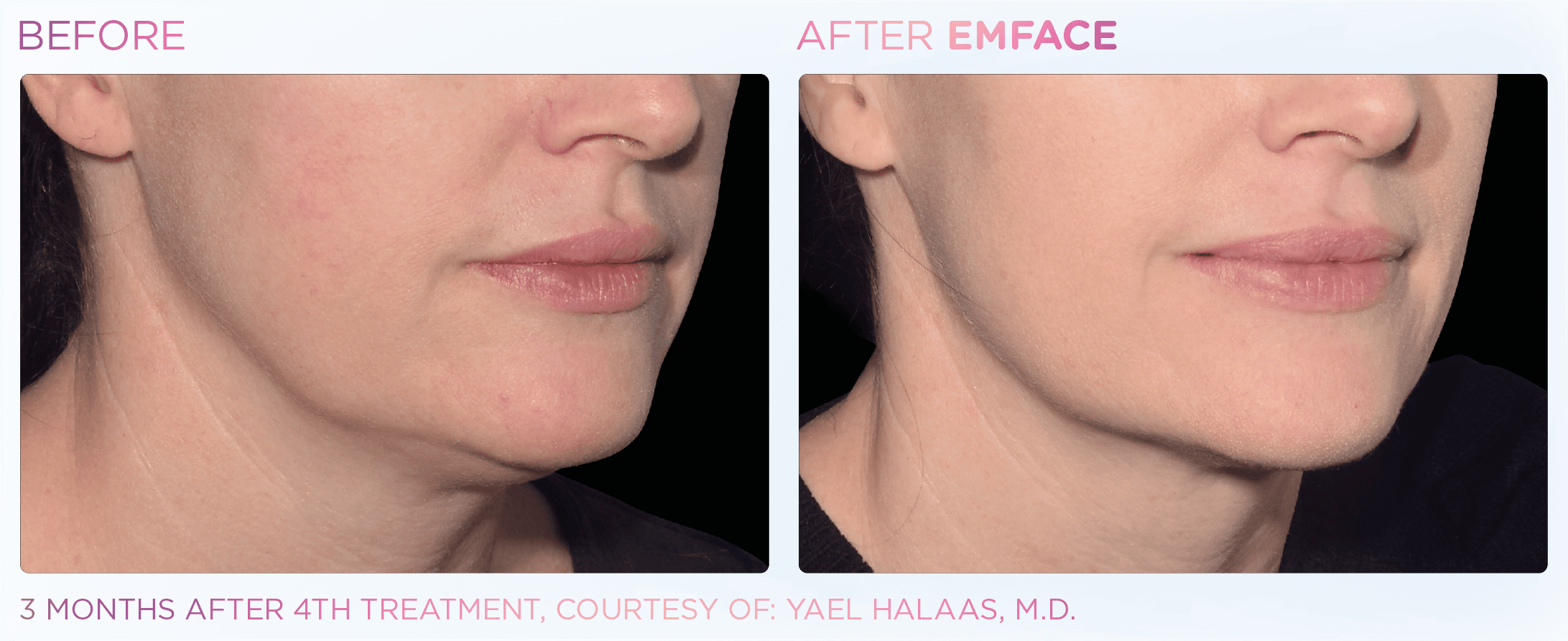 Enhanced jawline after treatment