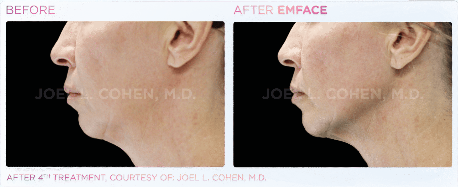 Profile view of jawline enhancement treatment