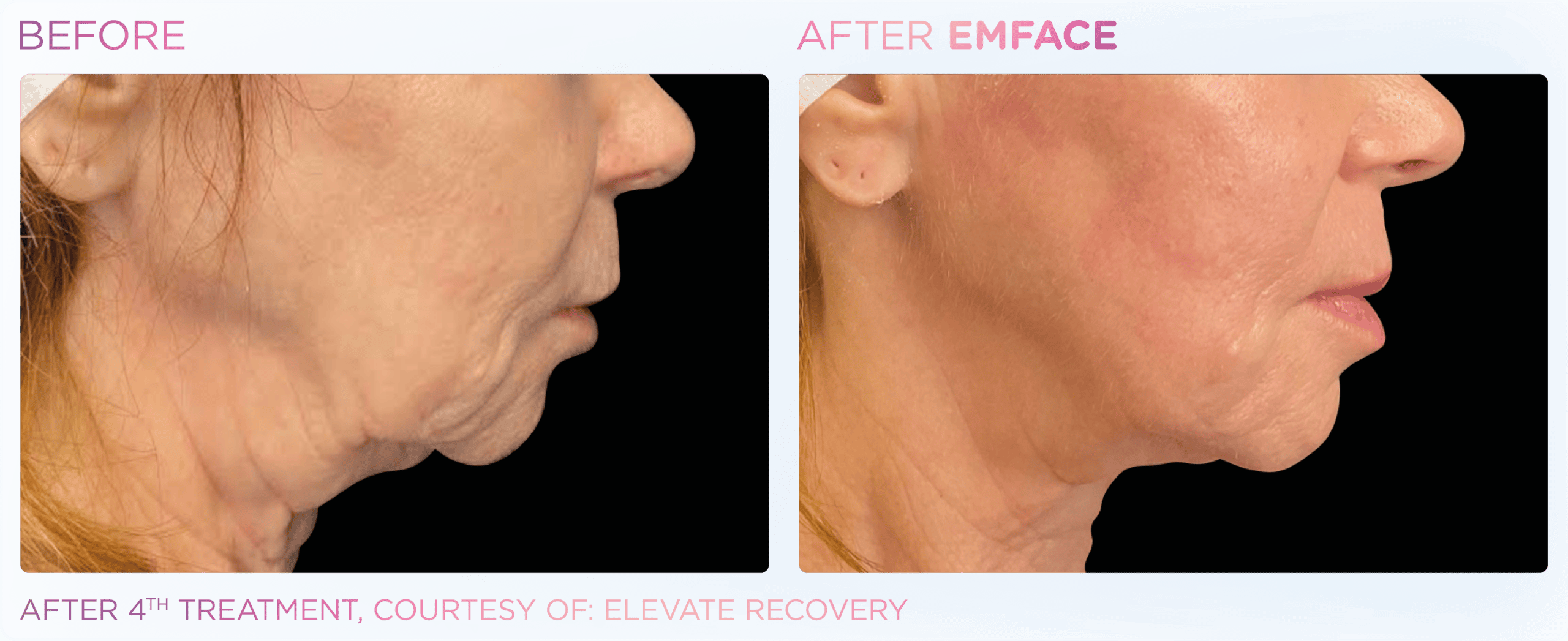 Improved jawline appearance after treatment