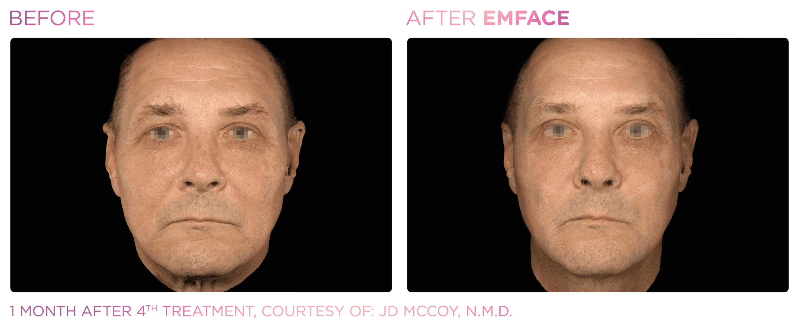 Male face treatment results overview