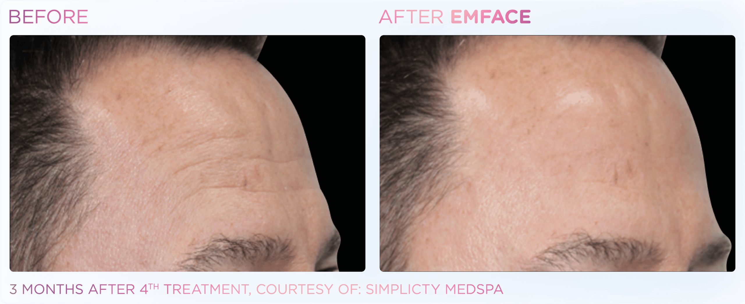 Before and after male forehead treatment