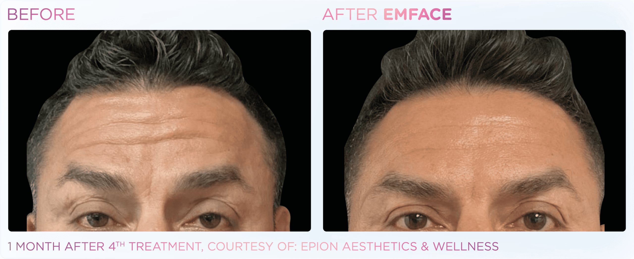 Man's forehead treatment results after procedure