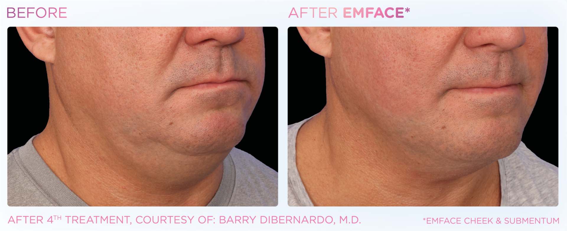 Facial treatment progress comparison