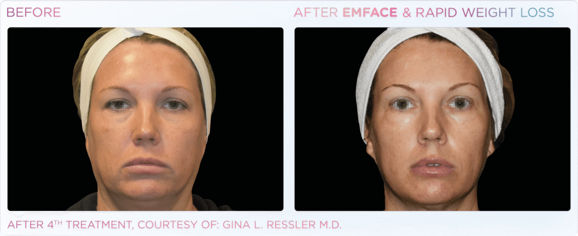 Before and after weight loss treatment