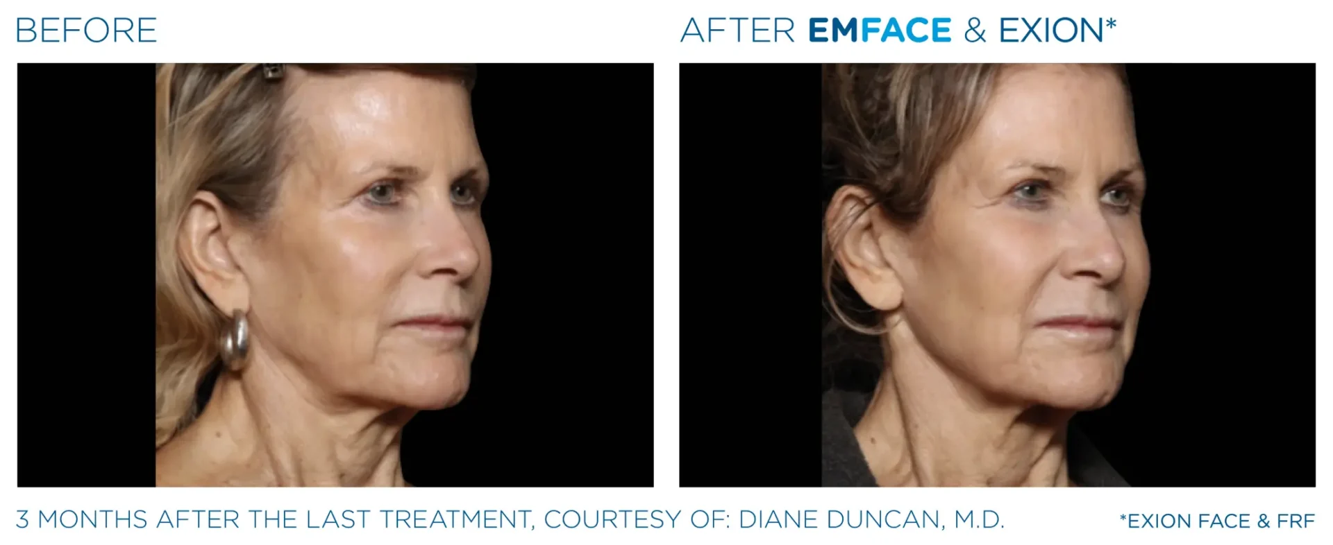 Anti-aging treatment results on woman's face