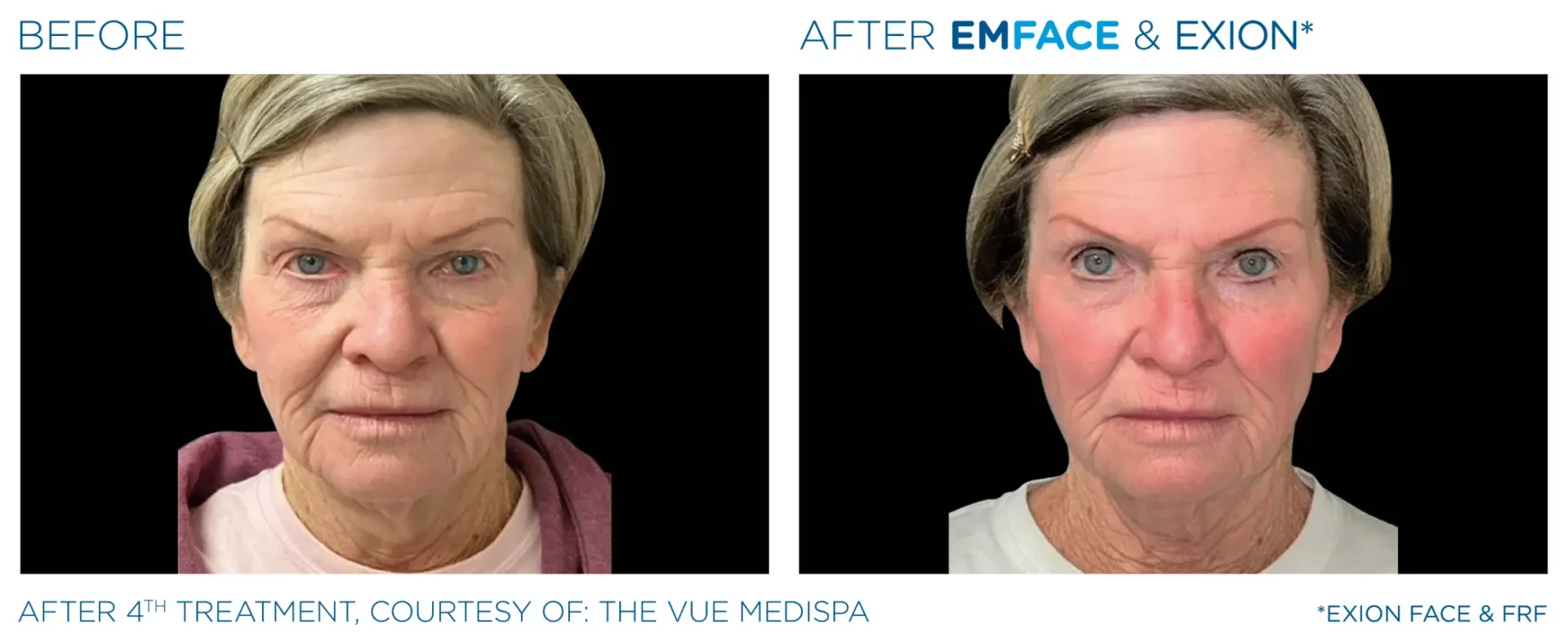 Facial rejuvenation results