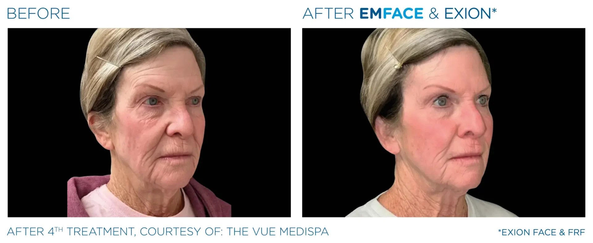 Aging skin comparison