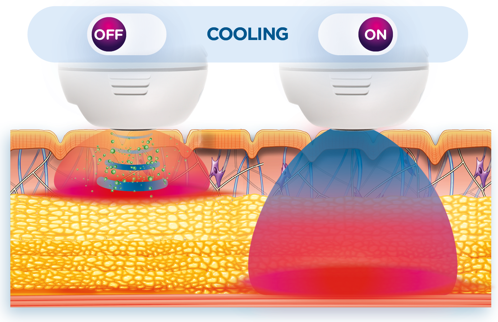 Cooling device comparison showing skin penetration