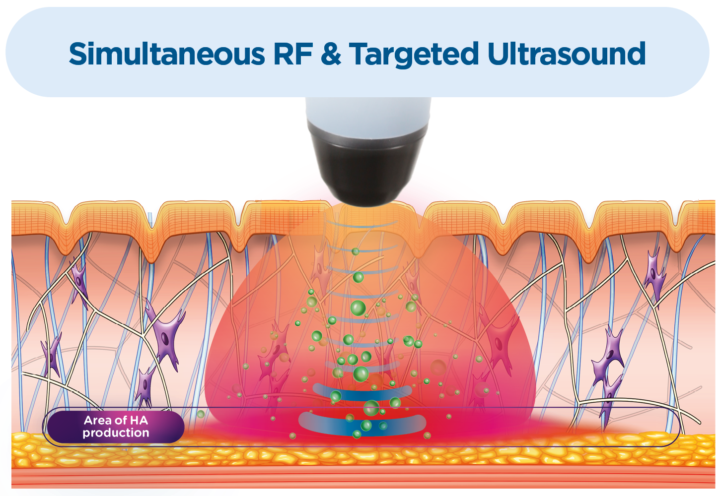 Simultaneous RF and targeted ultrasound skin treatment